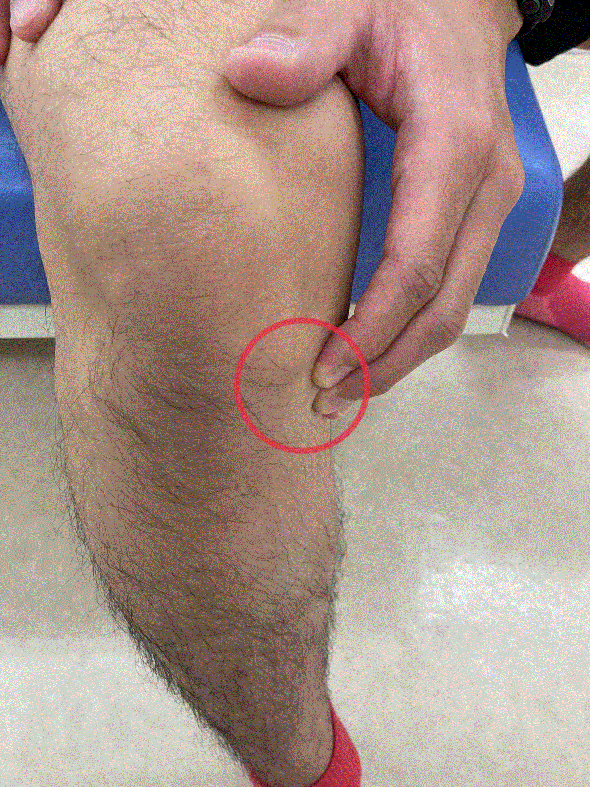 前十字靭帯損傷後 膝が伸ばしづらい方へ アーチフィジカルケアグループ
